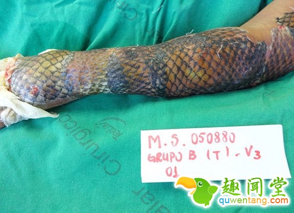 女子手臂烧伤后植入鱼皮有弹性 竟有如此神效！