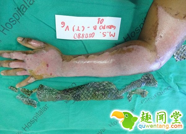 女子手臂烧伤后植入鱼皮有弹性 竟有如此神效！