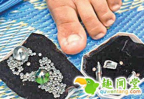 23岁女子得怪病脚趾不停吐钻石--见识多