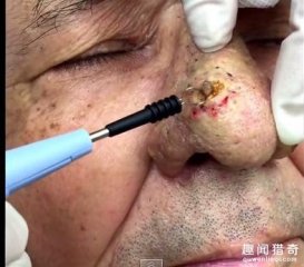 面部清洁太重要！男子懒得挤痘痘竟然累积