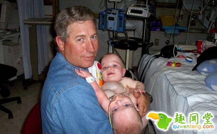 世界最罕见的连体婴，长大分开后的人生是这样