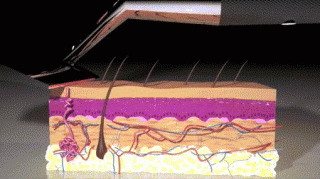 美研制新型激光剃须刀：瞬间熔化毛发不伤