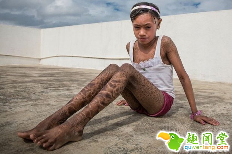 全身长满蛇皮，印度姐弟被全村人当成妖怪