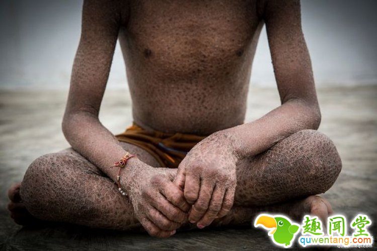 全身长满蛇皮，印度姐弟被全村人当成妖怪