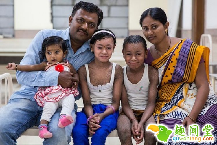 全身长满蛇皮，印度姐弟被全村人当成妖怪