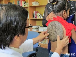 女孩背部长22公分巨痔，像龟壳一样几乎占