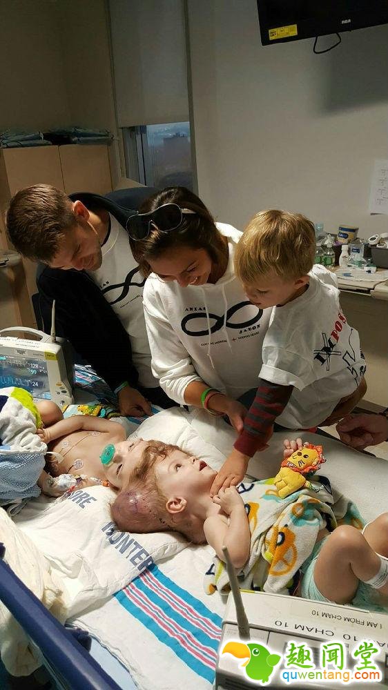 连体婴儿奇迹般存活！24小时的手术没有压倒美国这对双胞胎