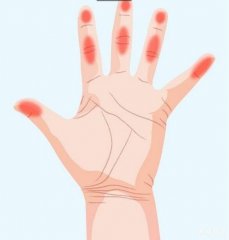 7种手痛代表身体已经在发出健康警讯，如